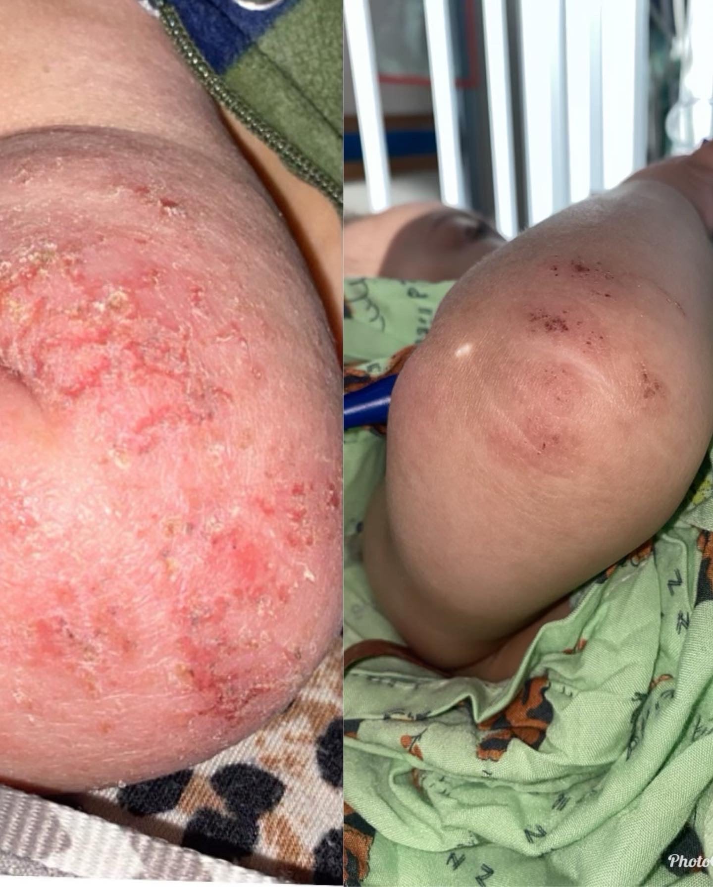Before and After Photo of Baby Elbow